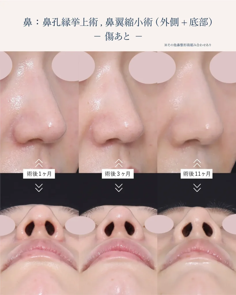 鼻孔縁挙上術の傷跡