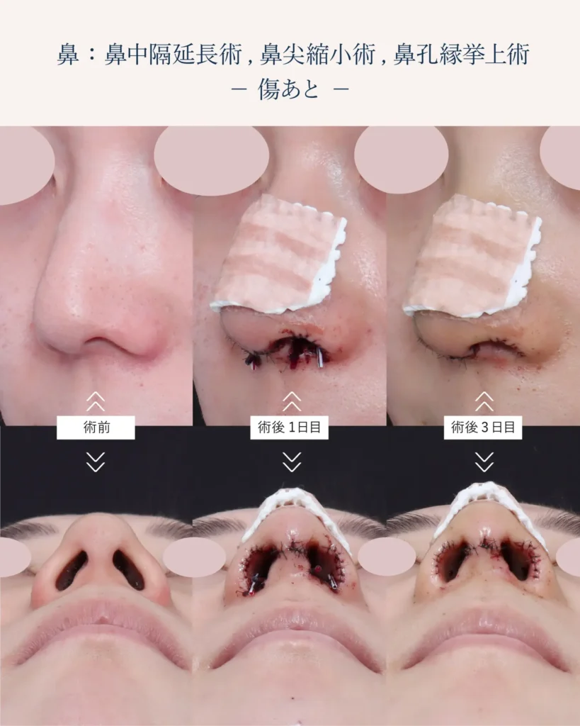 鼻孔縁挙上術の傷跡