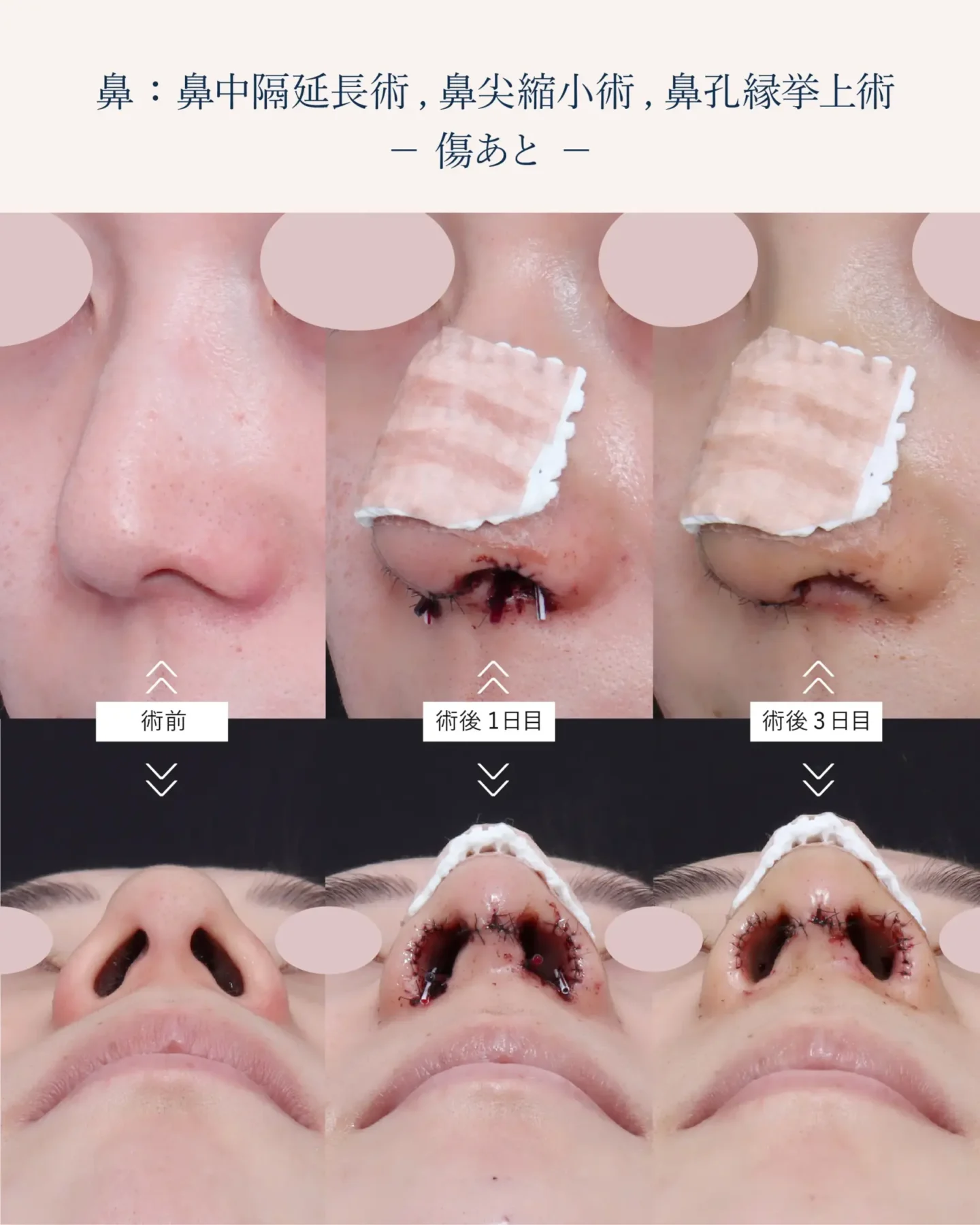 鼻孔縁挙上術の傷跡