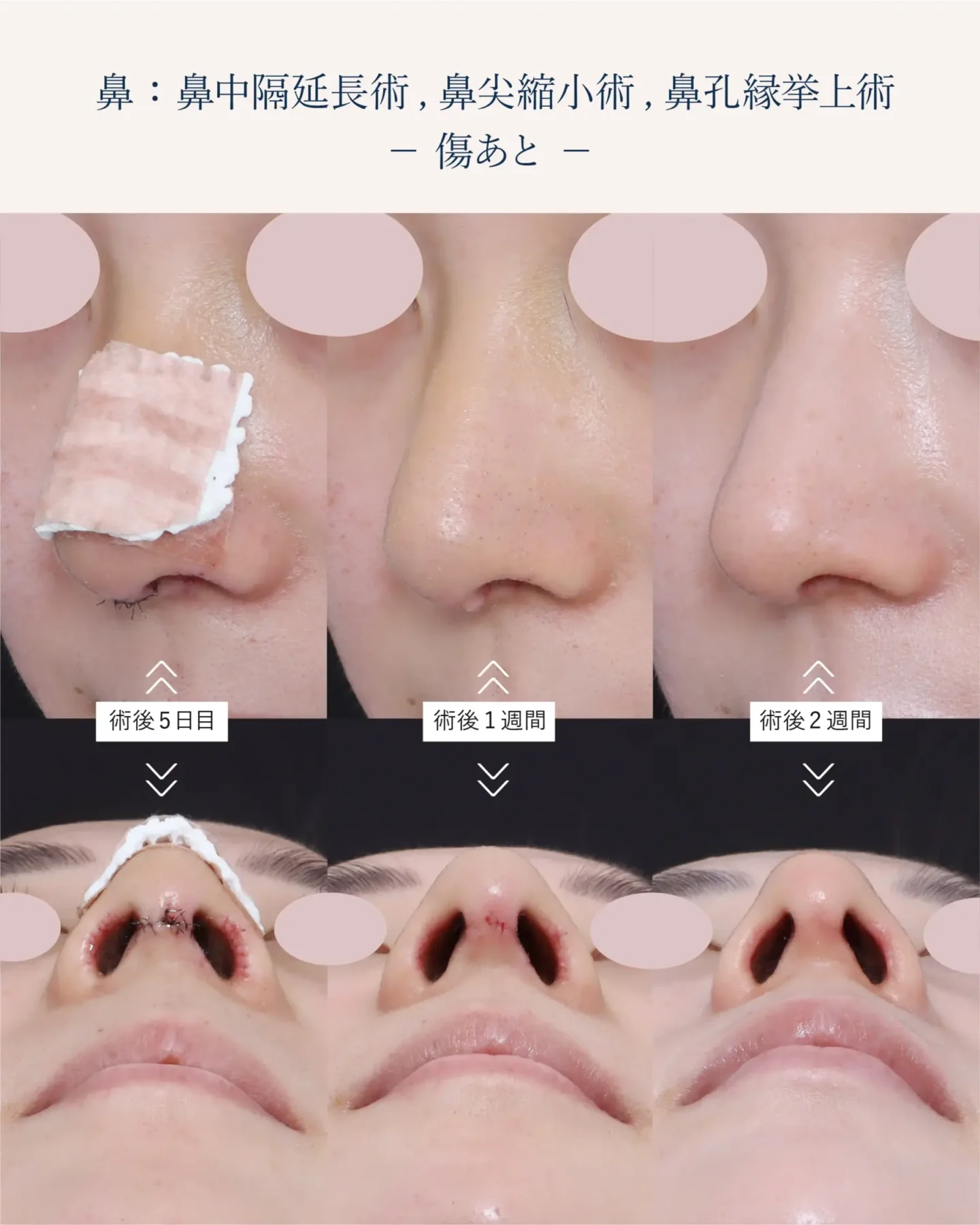鼻孔縁挙上術の傷跡
