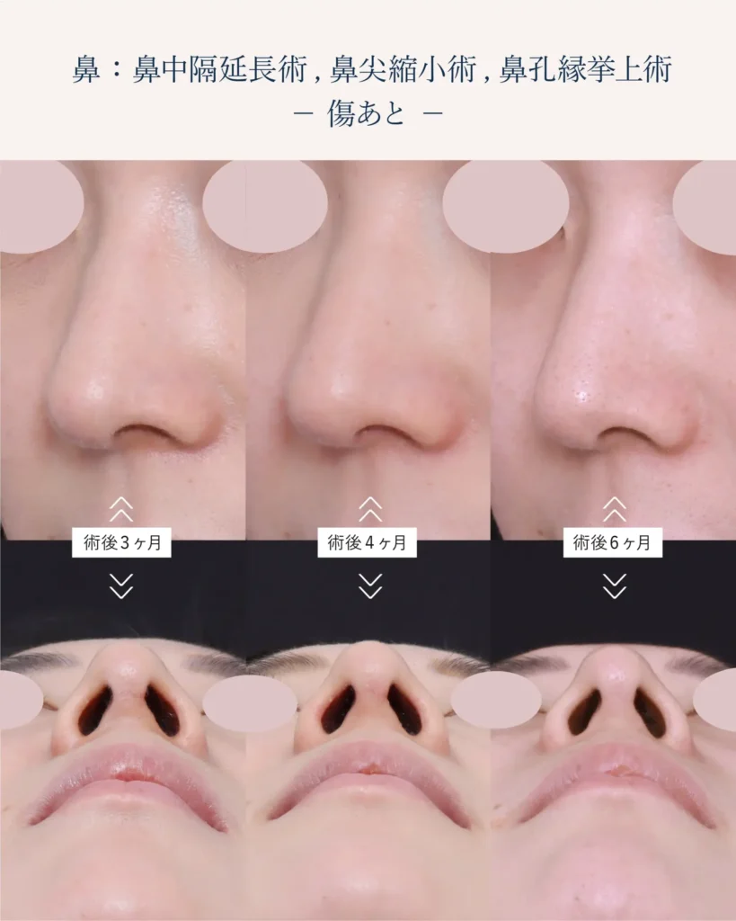鼻孔縁挙上術の傷跡