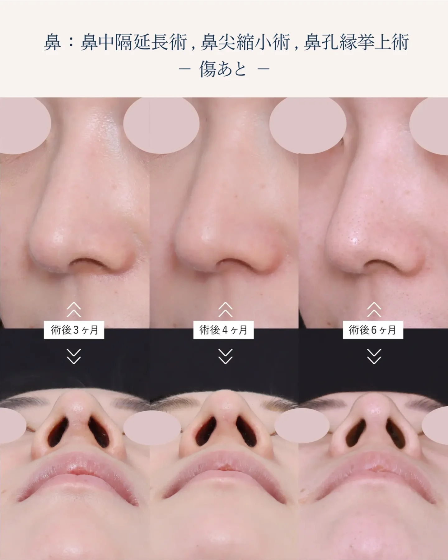鼻孔縁挙上術の傷跡