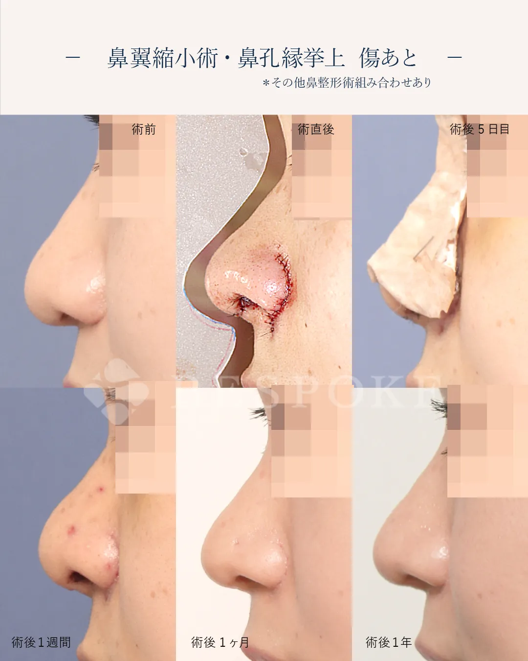 鼻孔縁挙上術の傷跡