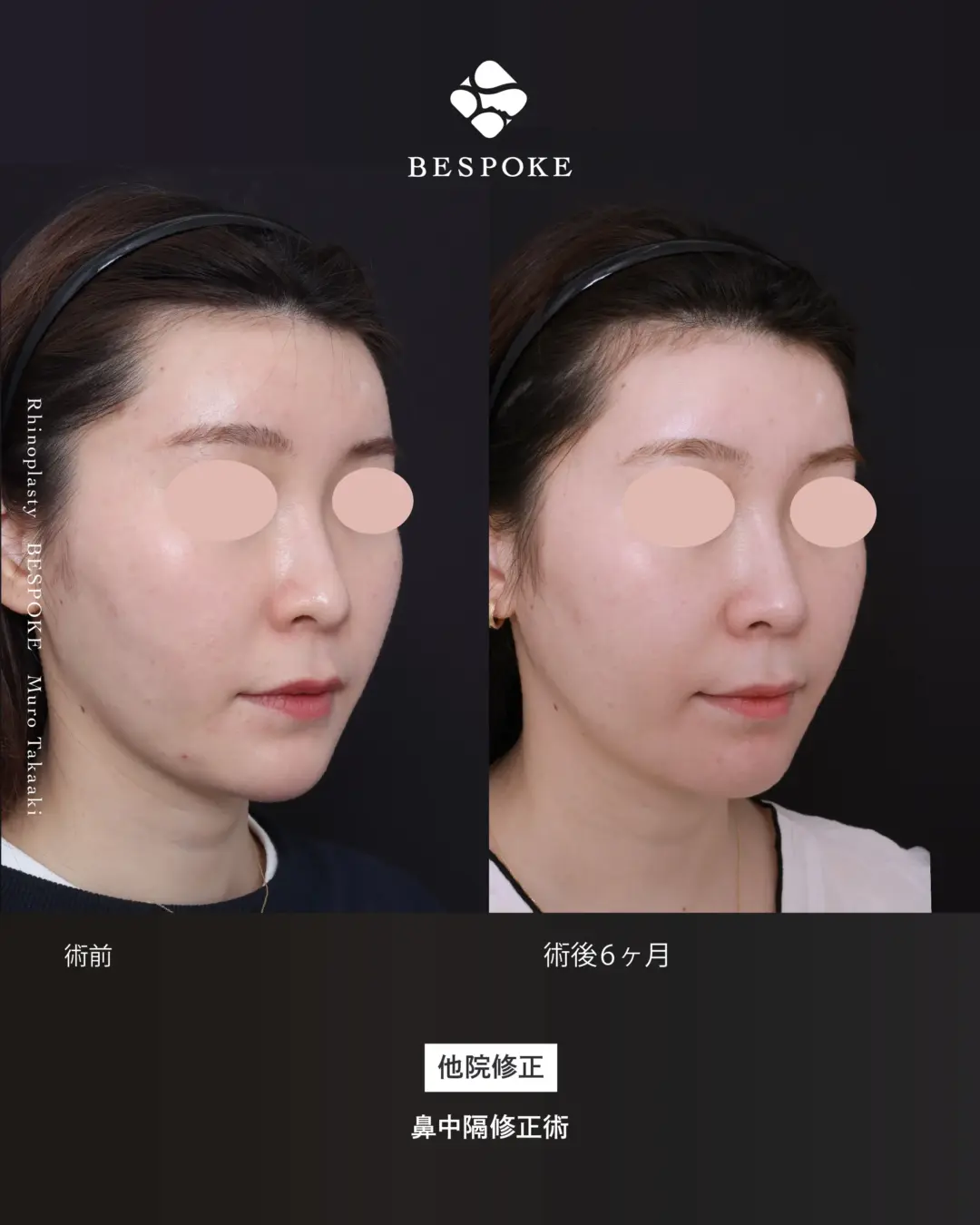 通常鼻17 (4) 鼻中隔修正術