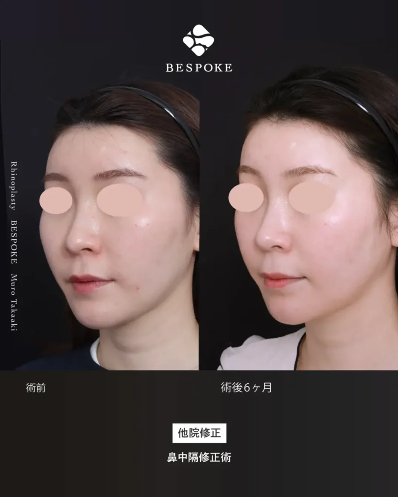 鼻中隔修正術