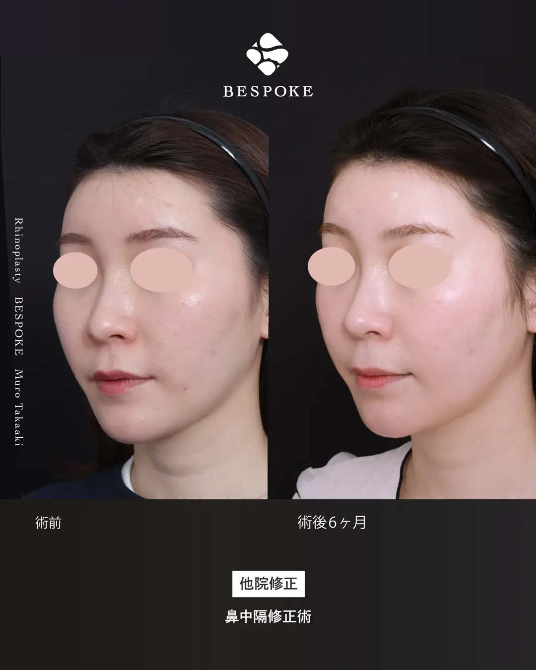 通常鼻17 (5) 鼻中隔修正術