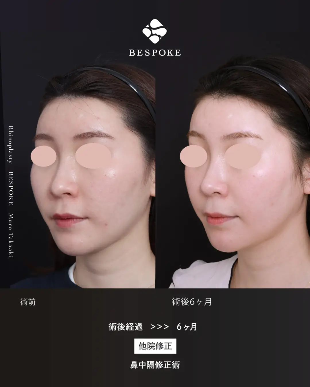 通常鼻17_傷跡 (5) 鼻中隔修正術の症例