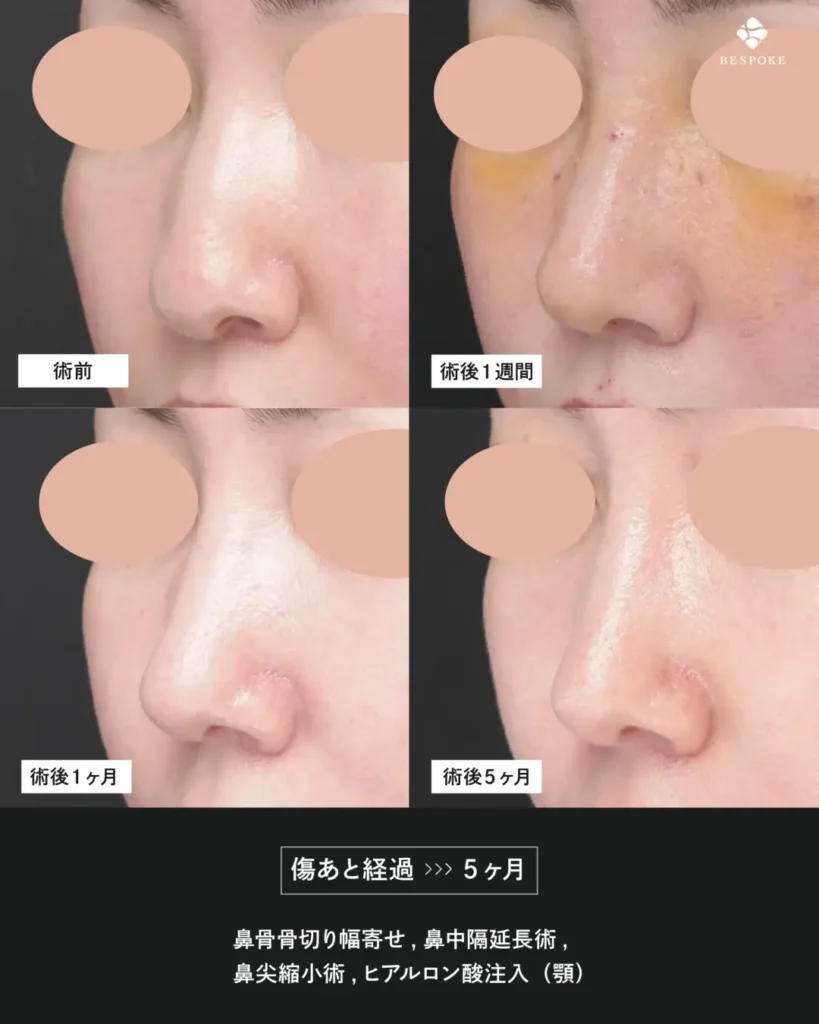 鼻骨骨切り幅寄せ術、鼻中隔延長術、鼻尖縮小術の症例