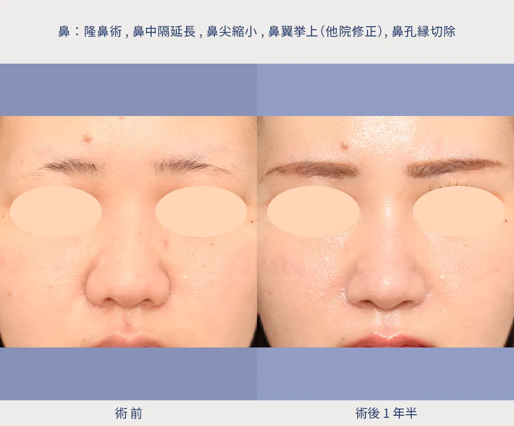 鼻尖溝03 (1) 隆鼻術、鼻中隔延長術、鼻尖縮小術、鼻翼挙上術、鼻孔縁切除の症例