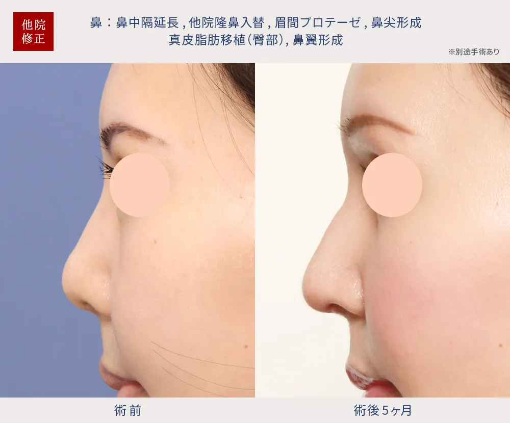 鼻尖溝04 (3) 鼻中隔延長術、隆鼻術、眉間プロテーゼ挿入術、鼻尖形成術、真皮脂肪移植、鼻翼形成術の症例