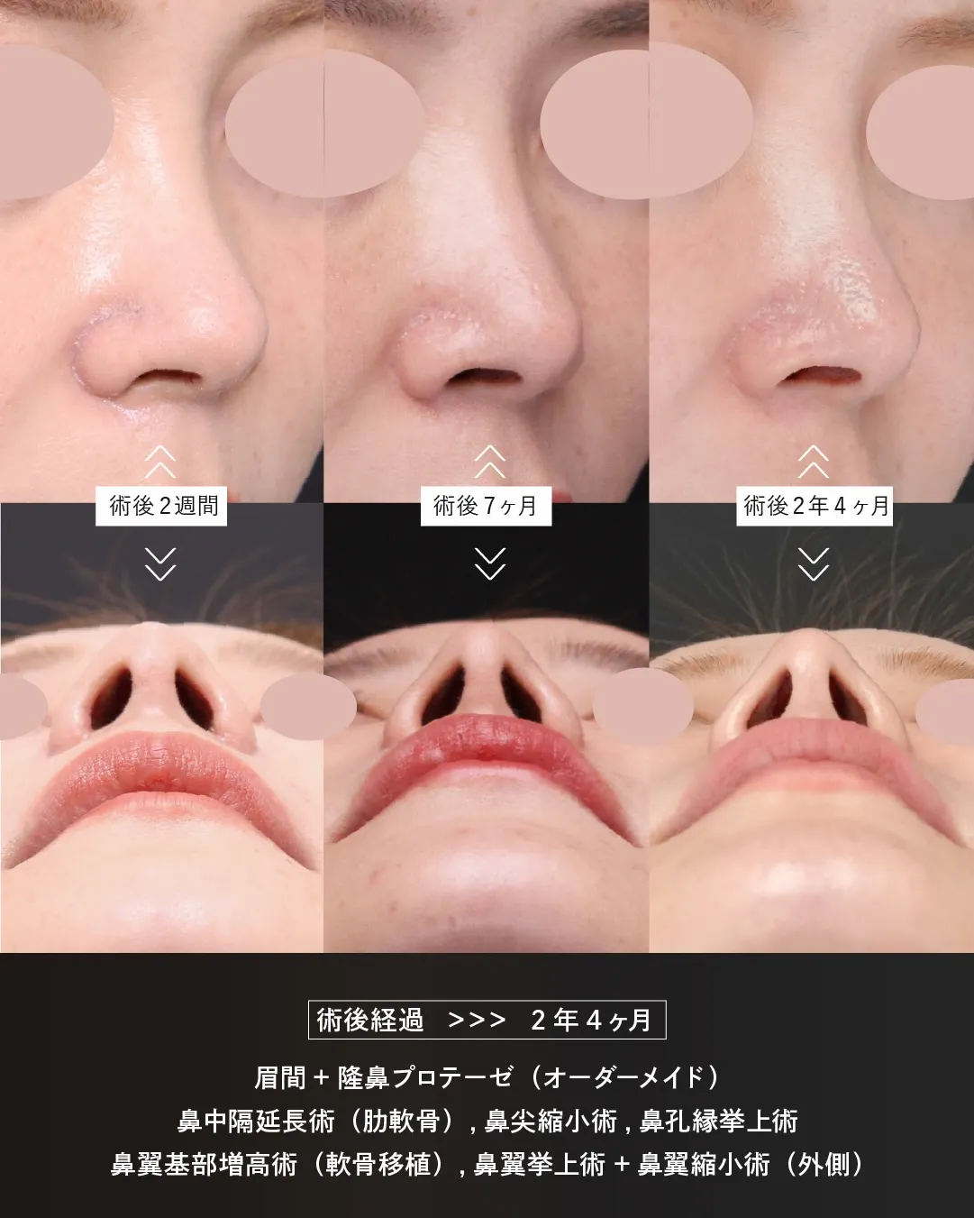 AANose (2) 眉間プロテーゼ挿入術、隆鼻術、鼻中隔延長術、鼻尖縮小術などの鼻整形の症例