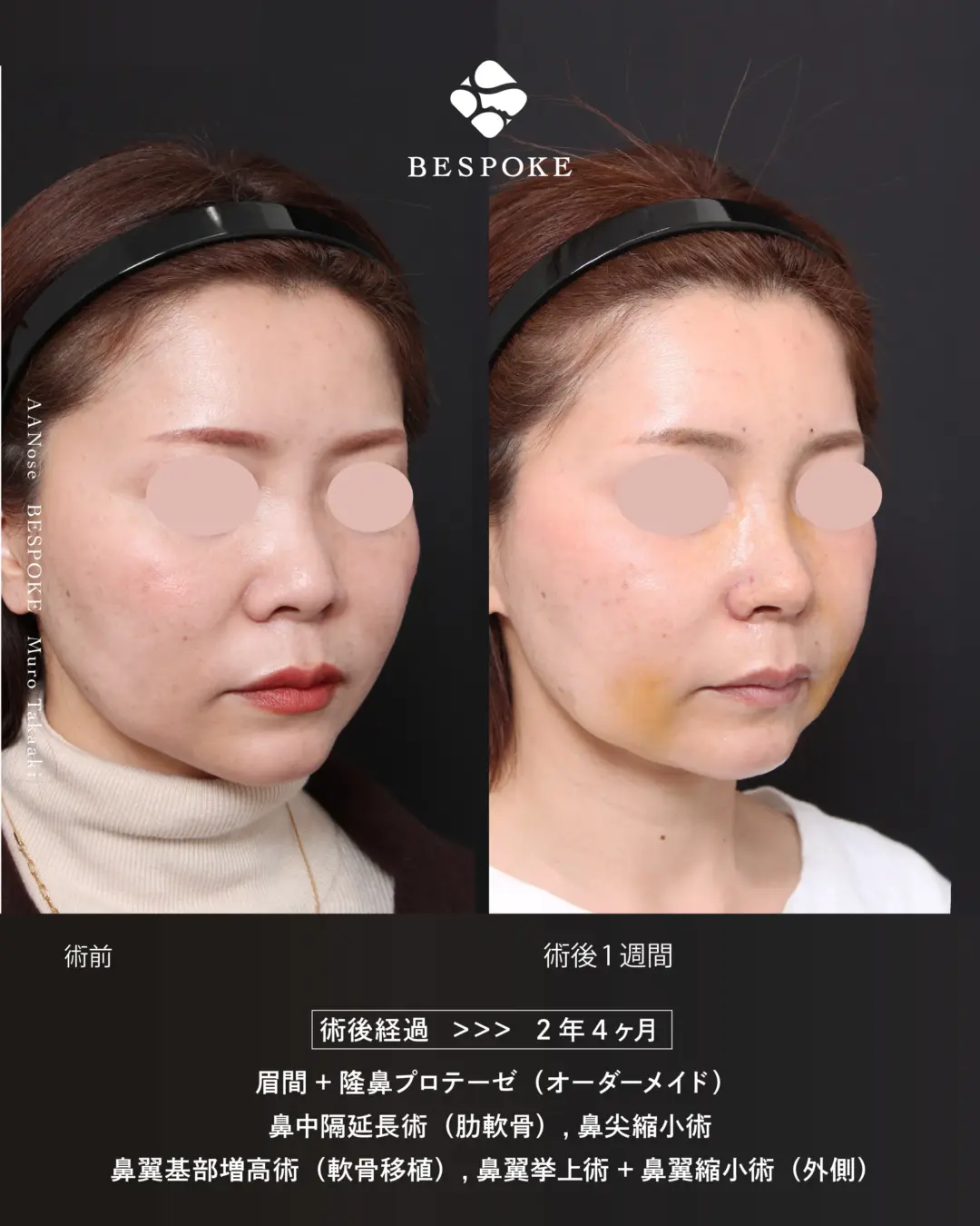 AANose (3) 眉間プロテーゼ挿入術、隆鼻術、鼻中隔延長術、鼻尖縮小術などの鼻整形の症例