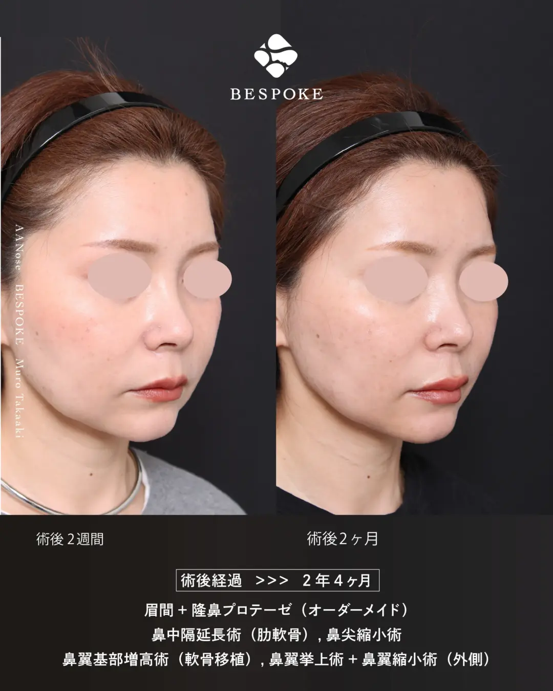 AANose (4) 眉間プロテーゼ挿入術、隆鼻術、鼻中隔延長術、鼻尖縮小術などの鼻整形の症例