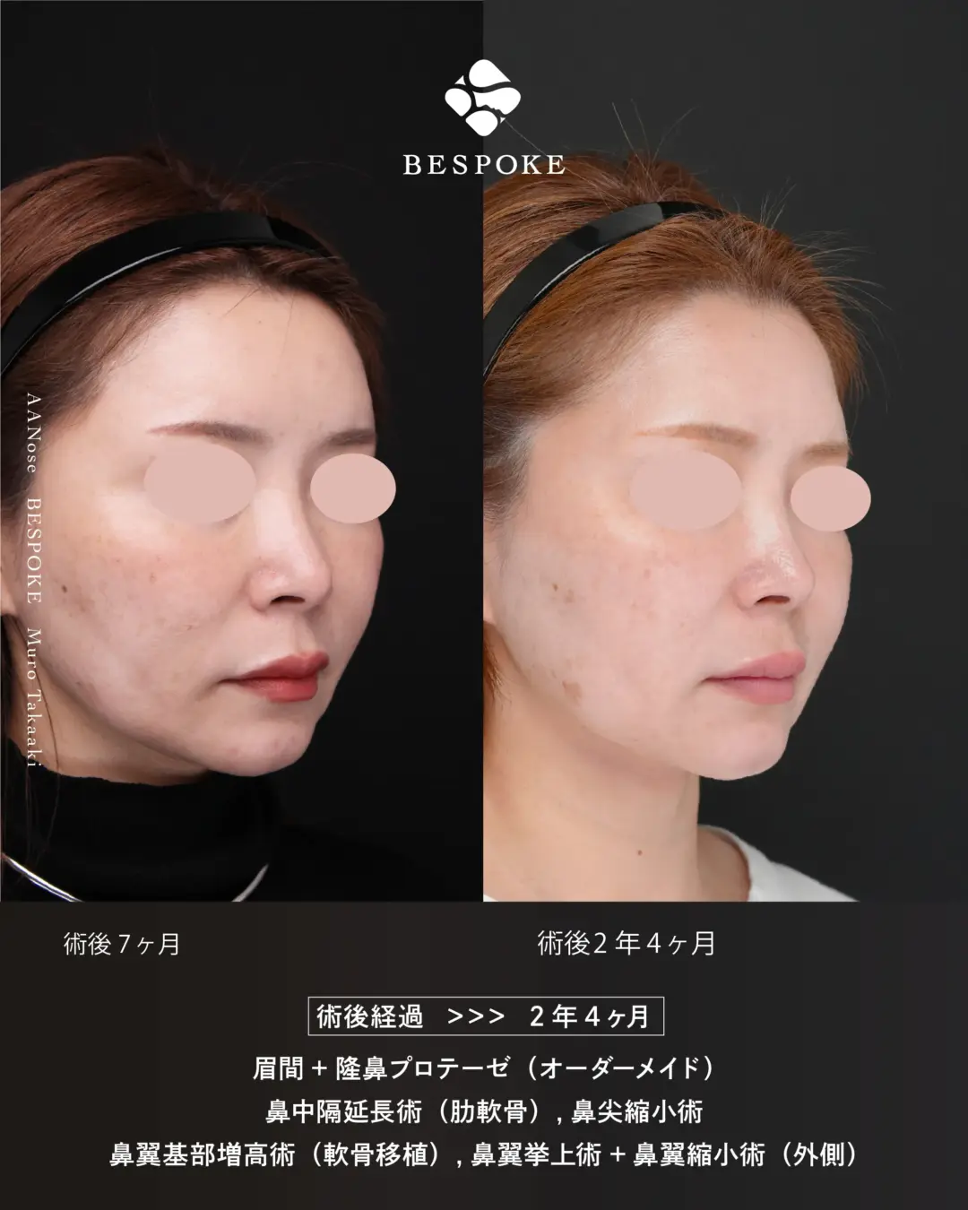 AANose (5) 眉間プロテーゼ挿入術、隆鼻術、鼻中隔延長術、鼻尖縮小術などの鼻整形の症例
