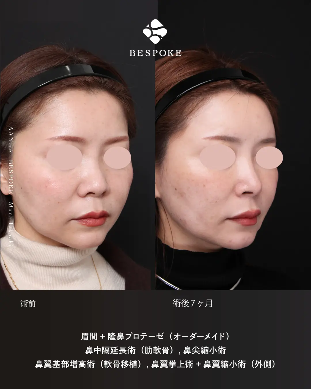 眉間プロテーゼ挿入術、隆鼻術、鼻中隔延長術、鼻尖縮小術などの鼻整形の症例