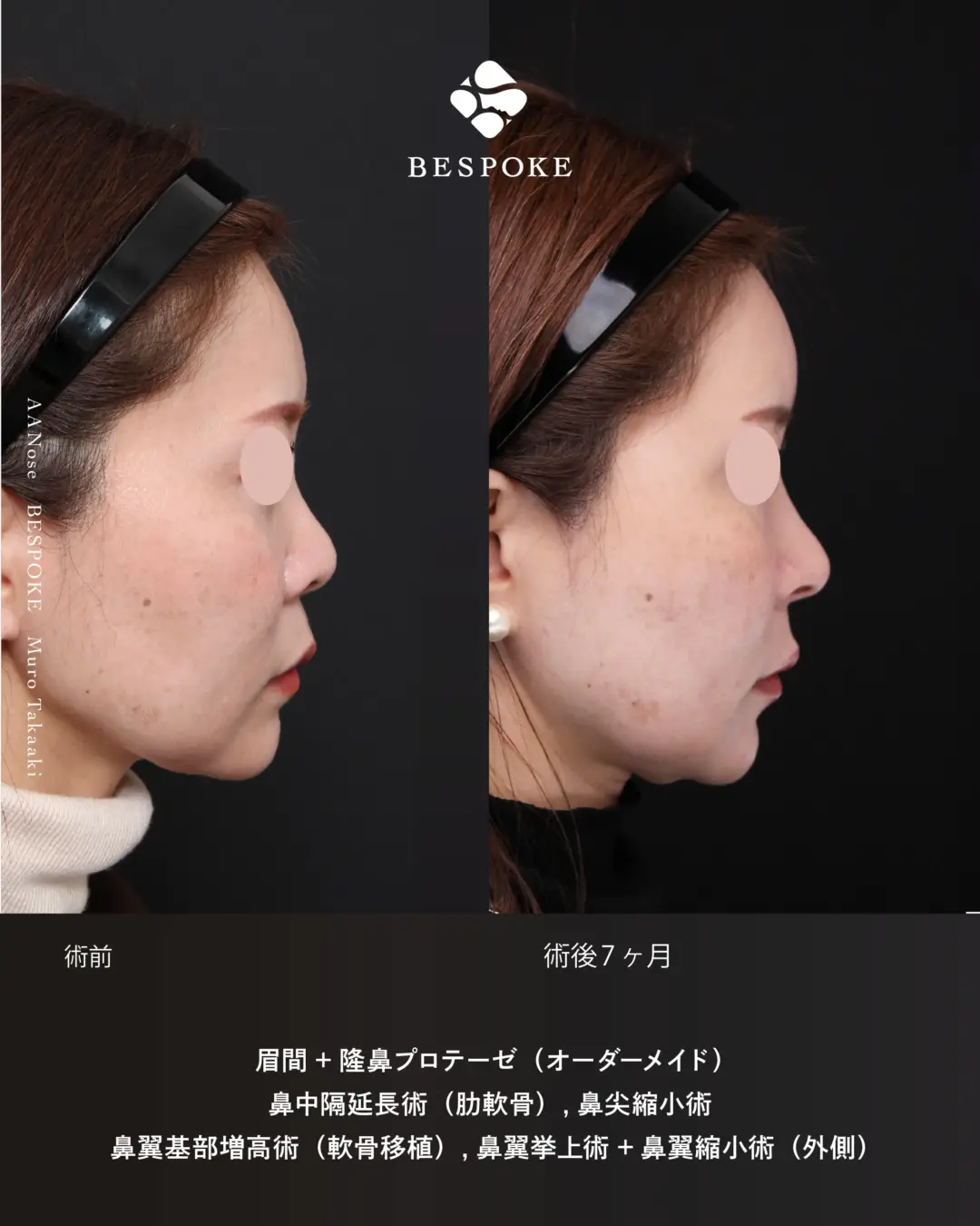 眉間プロテーゼ挿入術、隆鼻術、鼻中隔延長術、鼻尖縮小術などの鼻整形の症例