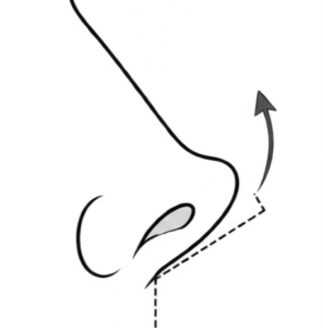 豚鼻_図解