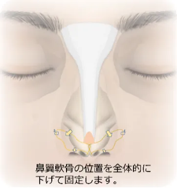 鼻翼延長術_図解