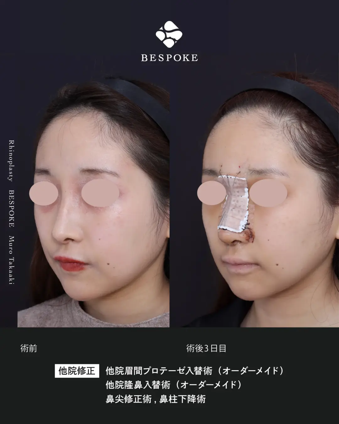 他院隆鼻入替 (1) 他院眉間入替術・隆鼻入替術・鼻尖修正術・鼻柱下降術