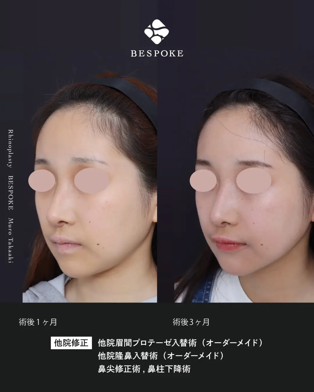 他院隆鼻入替 (2) 他院眉間入替術・隆鼻入替術・鼻尖修正術・鼻柱下降術