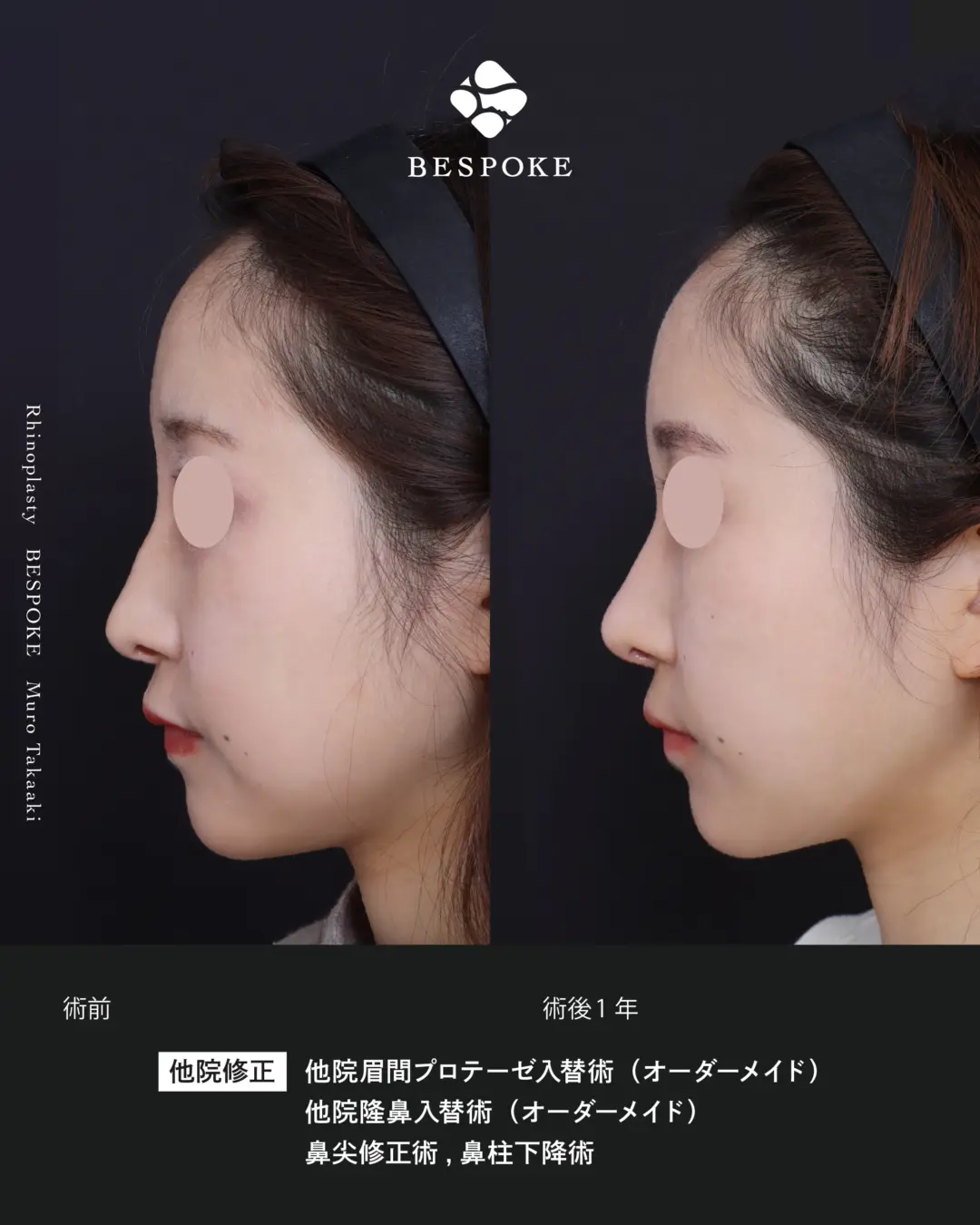 他院隆鼻入替 (3) 他院眉間入替術・隆鼻入替術・鼻尖修正術・鼻柱下降術