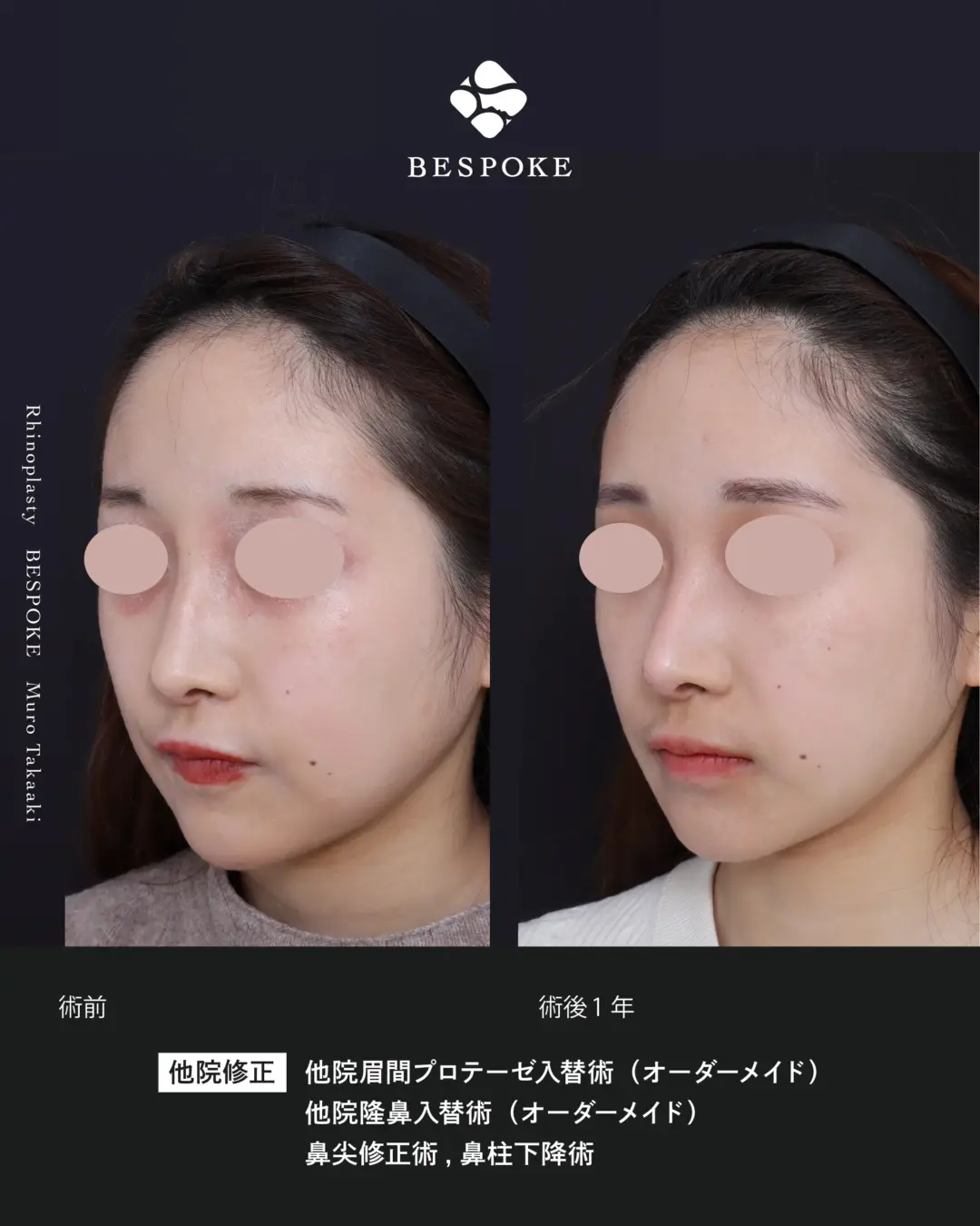 他院での鼻整形後にオーダーメイドプロテーゼに入れ替えて自然で、幼く、透明感のある鼻へ修正