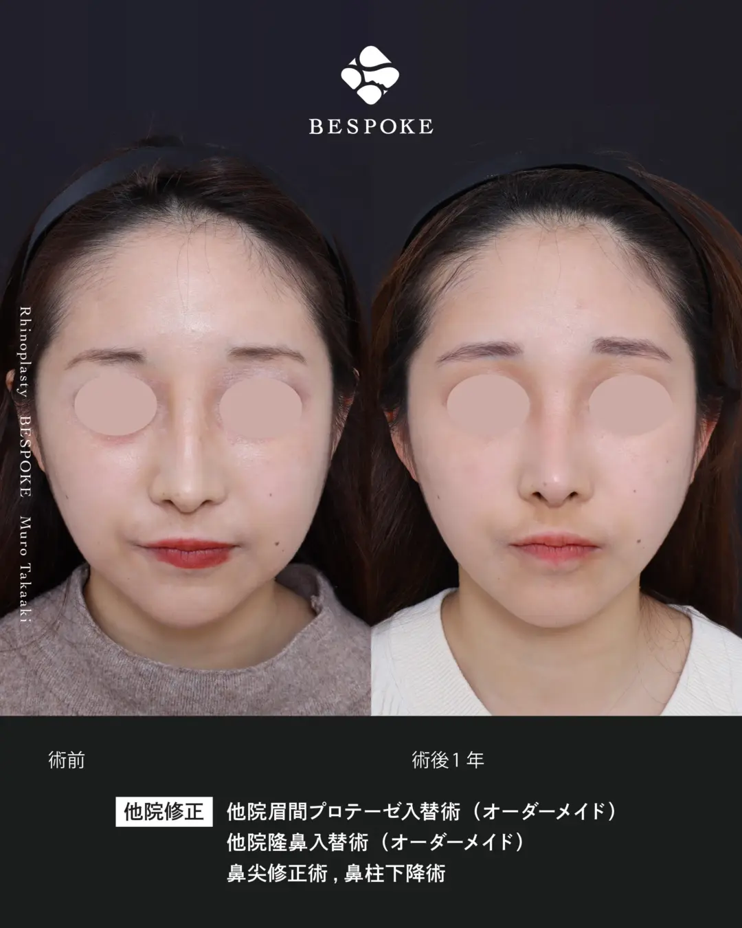 他院隆鼻入替 (5) 他院眉間入替術・隆鼻入替術・鼻尖修正術・鼻柱下降術