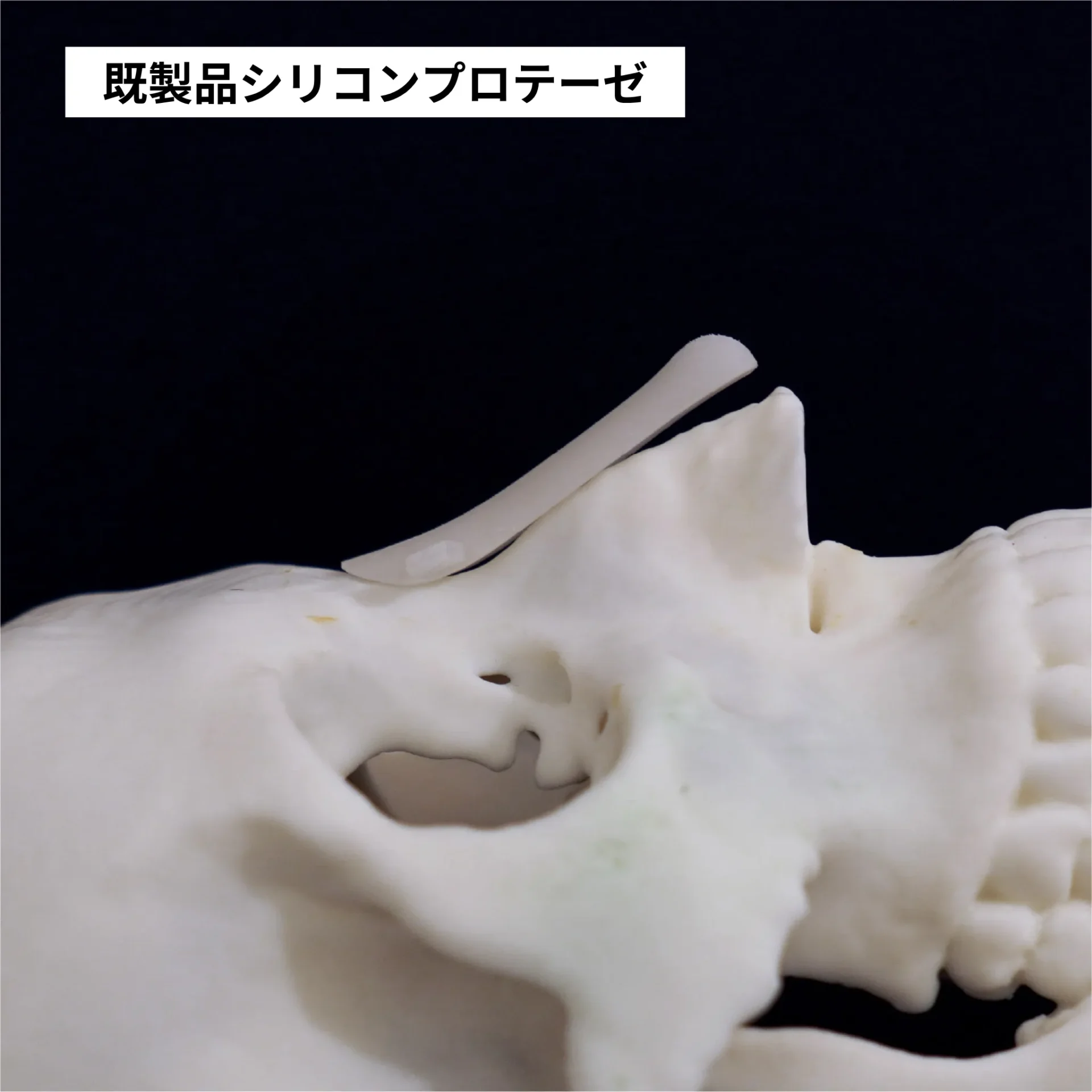 既製品シリコンプロテーゼ